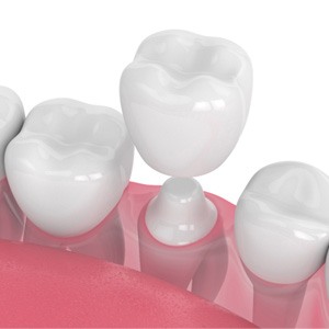 Illustration of dental crown being placed on tooth