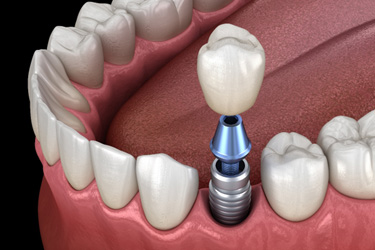 Illustration of single dental implant