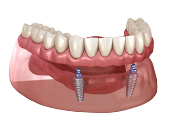 Illustration of implant denture
