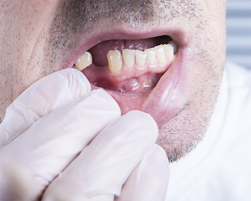 Close up of a mouth with a missing lower tooth