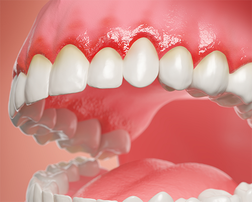 Illustrated mouth with red gums