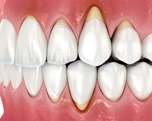 Illustrated mouth with receding gums