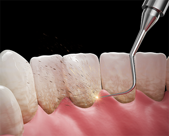 Illustration of a dental scaler clearing tartar