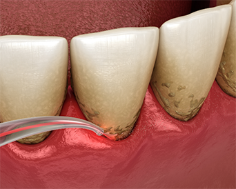 Illustration of a laser treating the gums