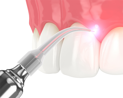 Illustration of a laser treating the gums