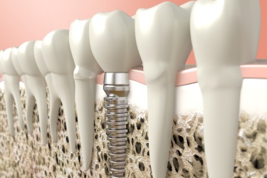 Digital illustration of a dental implant