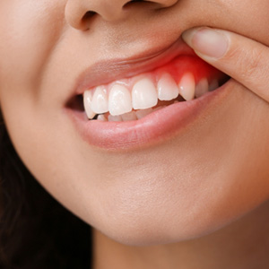 A woman revealing her red and inflamed gums